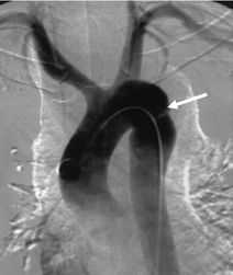 Аортография