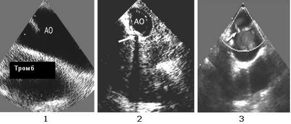 Транспищеводная ЭхоКГ