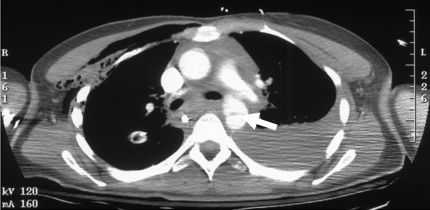 Формирование псевдоаневризмы