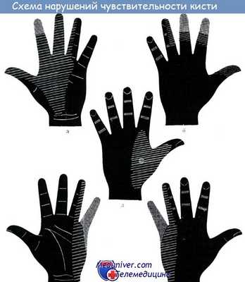 Схема нарушений чувствительности кисти при повреждении нервов