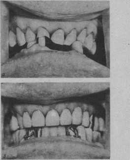 Рис. 23. Устранение нарушений окклюзии при деформации зубных рядов с патологической стираемостью с понижением межальвеолярной высоты и нижней трети лица.