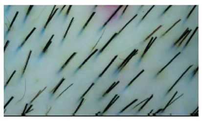 Заболевания волос - снижение плотности волос