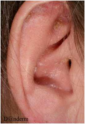 Заболевания волос - себорейный дерматит