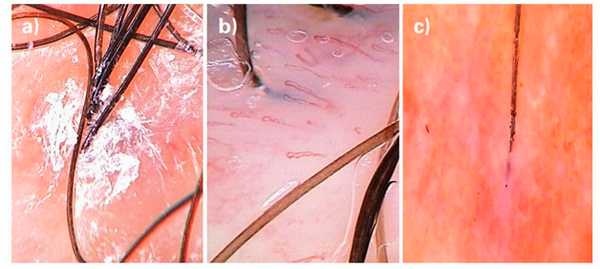 Заболевания волос - признаки рубцовой алопеции