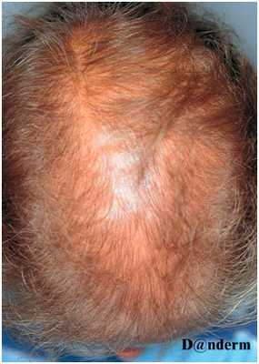 Заболевания волос - алопеция после химиотерапии