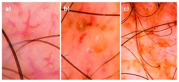 Заболевания волос - признаки алопеции при волчанке