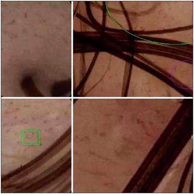 Заболевания волос - признаки себорейного дерматита