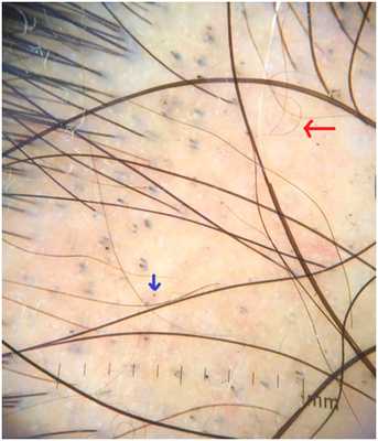 Заболевания волос - признаки очаговой алопеции