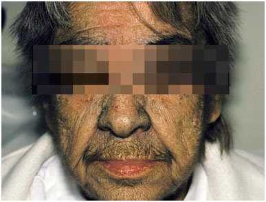 Причины возникновения гирсутизма, аппаратные методики удаления волос лазерами и IPL-устройствами