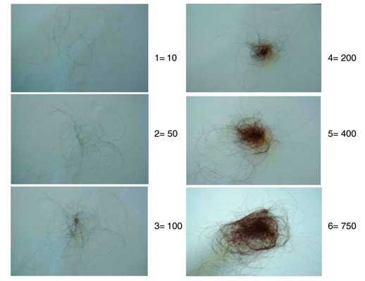 Заболевания волос - степени выпадения волос