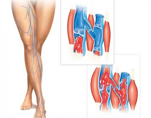 Венозная недостаточность