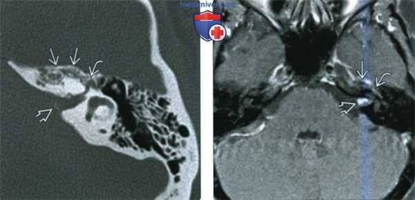 КТ, МРТ при венозной мальформации лицевого нерва (ВМЛН) в височной кости
