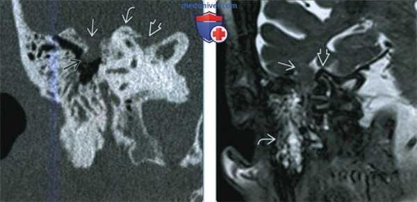 Истечение ликвора в височной кости - лучевая диагностика