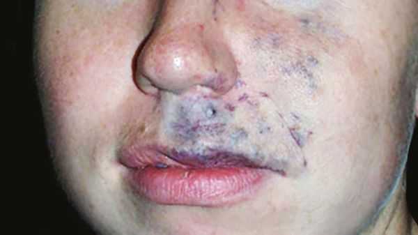 Венозная мальформация