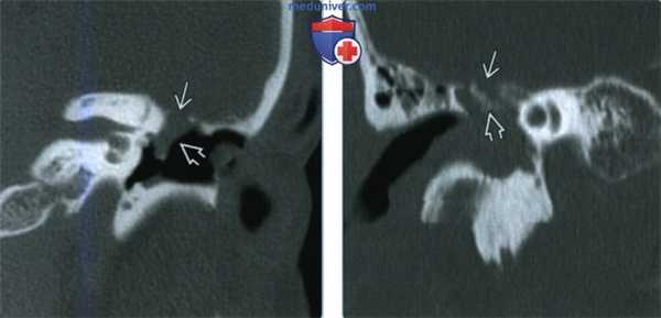 Истечение ликвора в височной кости - лучевая диагностика