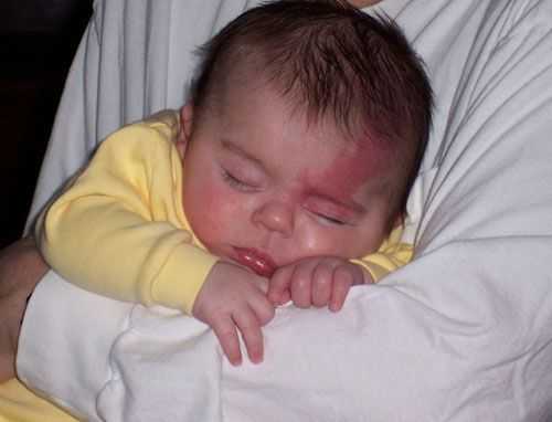 Капиллярная мальформация при синдроме Штурге — Вебера