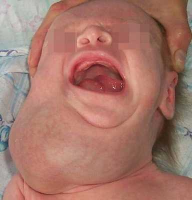 лимфатическая мальформация шеи