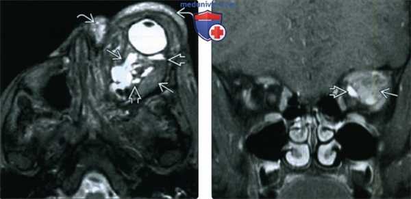 КТ, МРТ при лимфатической мальформации глазницы