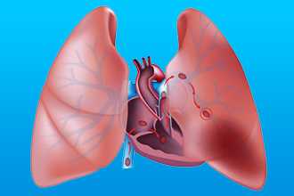 Легочное сердце (ЛС)
