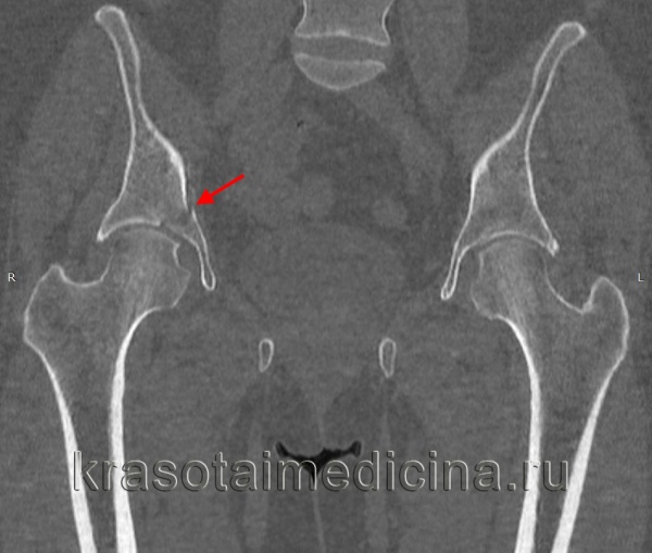 Перелом бедра