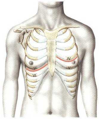 Переднебоковой межреберный доступ без пересечения реберных хрящей.