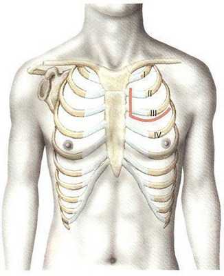 Переднебоковой межреберный доступ с пересечением реберных хрящей.