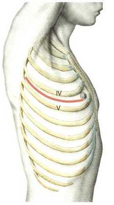 Боковой межреберный доступ.