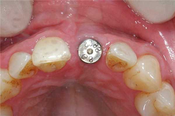 Формирователь десны