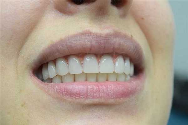 Имплантация верхней челюсти