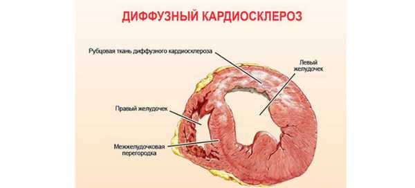 Диффузный кардиосклероз