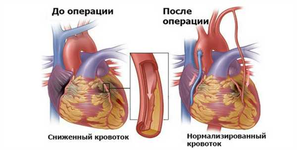 Нормализированный кровоток