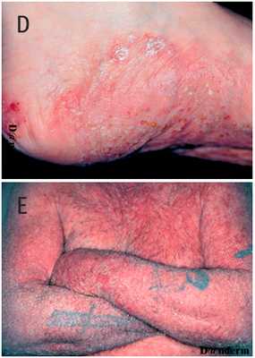 Псориаз типов D и E