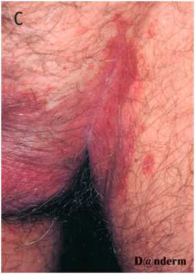 Псориаз типа C