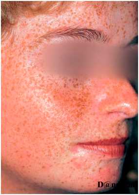 Множественные эфелиды (веснушки) на лице