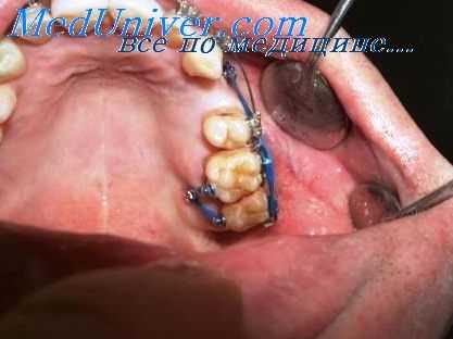 вестибулярное положение зубов