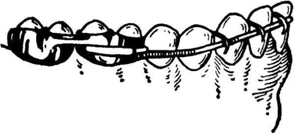 Коррекция положения нижних зубов