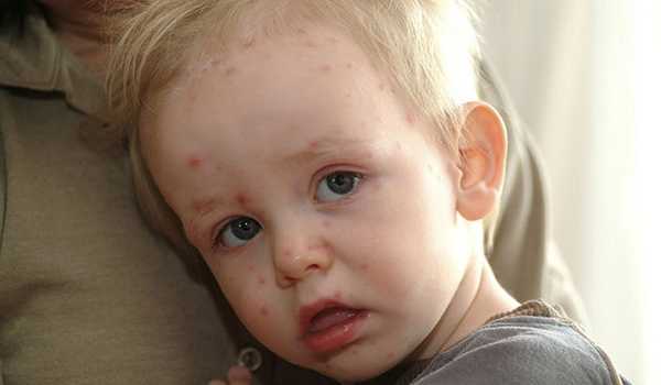 Ветрянка у детей