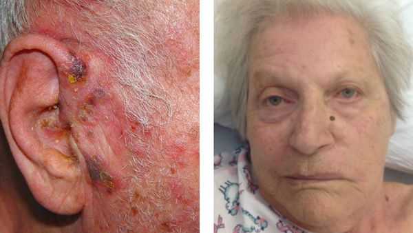 Высыпания в ухе и парез лицевого нерва