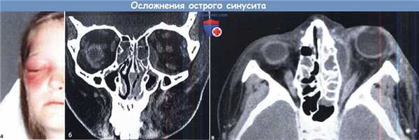 Осложнения острого синусита
