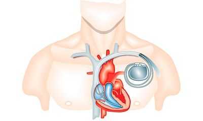Кардиостимулятор
