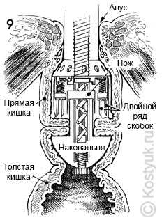 тостокишечно-ректальный анастомоз хирургическим степлером 9