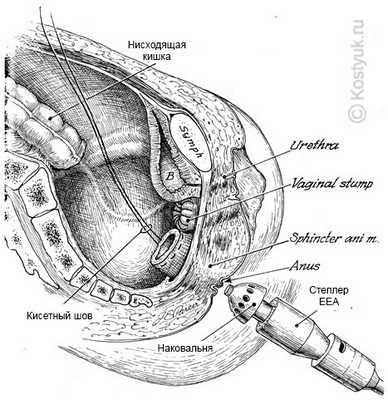 Хирургический степлер