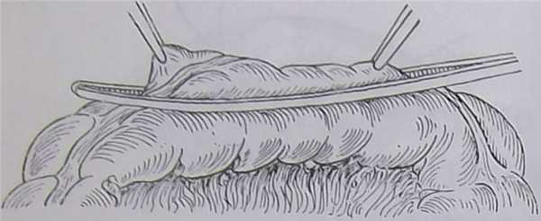 Наложение кишечного жома