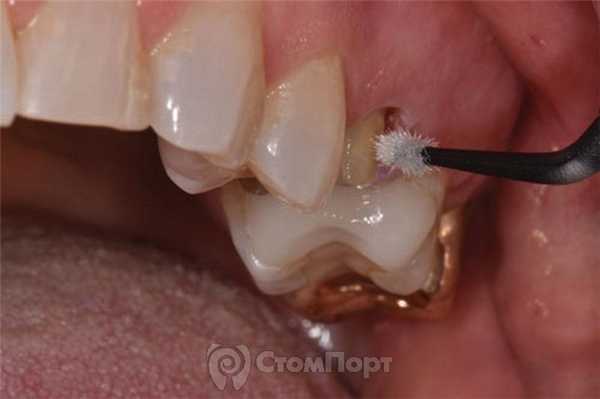 3. Нанесение Futurabond U от Voco