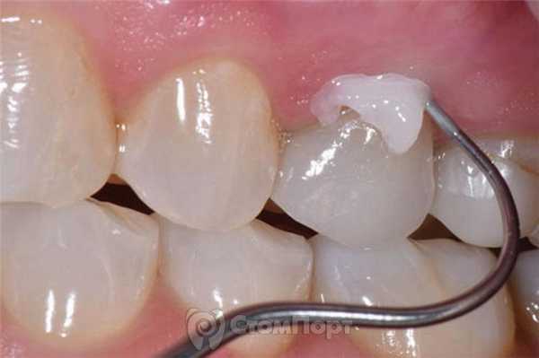 6. Удаление излишков цемента