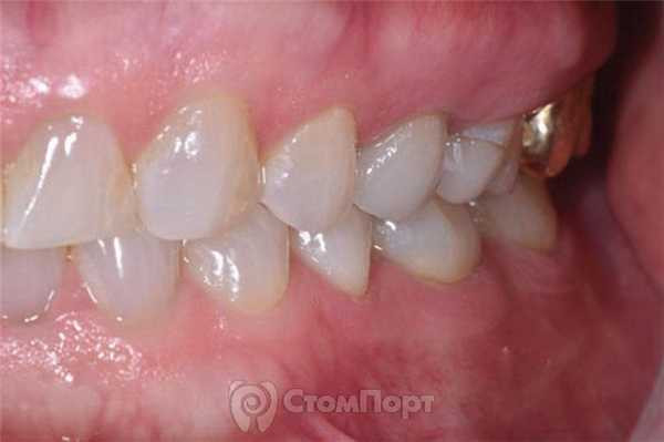 7. Финишная полировка реставрации