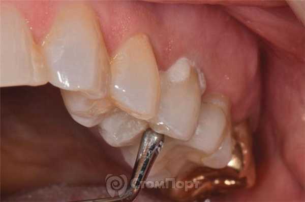 4. Фиксация реставрации