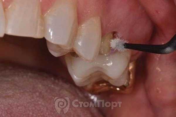 Цементация и бондинг