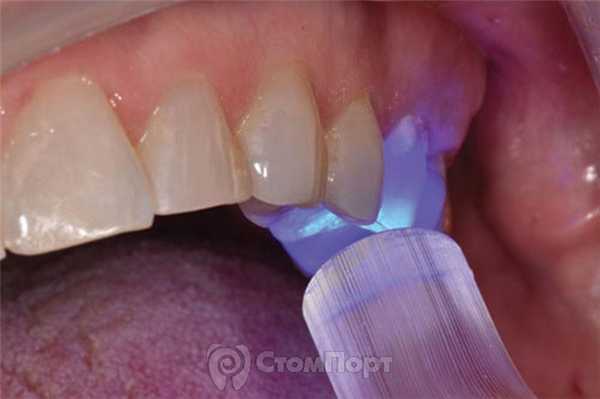 5. Засветка реставрации