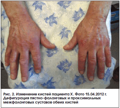Рис. 2. Изменение кистей пациента Х. Фото 15.04.2012 г. Дефигурация пястно-фаланговых и проксимальных межфаланговых суставов обеих кистей